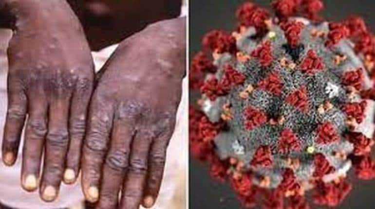 Monkeypox vs COVID: कोरोना को टक्कर दे रहा है मंकीपॉक्स, मिलते-जुलते हैं दोनों के लक्षण, जानिए कैसे करें पहचान?