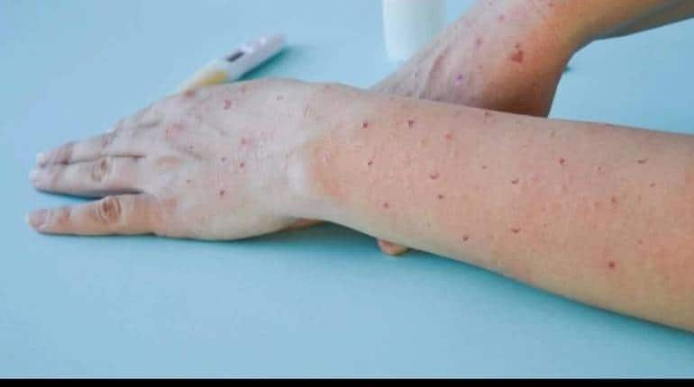 Monkeypox: ICMR ने रिसर्च में किया खुलासा, UAE से लौटे दो यात्री A.2 वेरिएंट से थे संक्रमित Monkeypox: ICMR ने रिसर्च में किया खुलासा, UAE से लौटे दो यात्री A.2 वेरिएंट से थे संक्रमित
