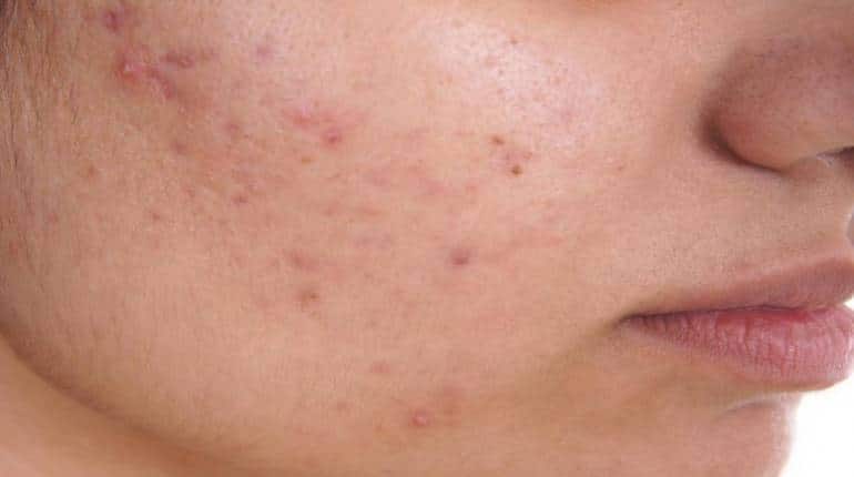 Skin Care: इन विटामिन्स की कमी से चेहरे पर नजर आते हैं दाग-धब्बे, जानिए कैसे करें दूर