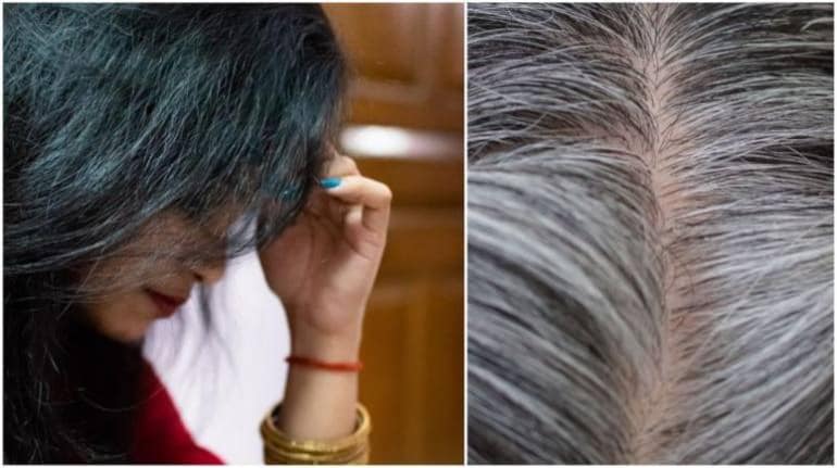 कम उम्र में बाल क्यों होने लगते हैं सफेद? जानिए वजह और उपाय - White hair  problem why does hair turn grey at a young age know treatment |  Moneycontrol Hindi