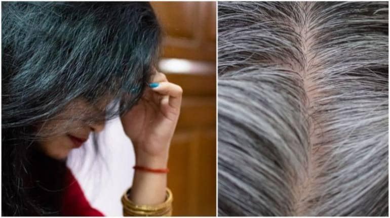 कम उम्र में बाल क्यों होने लगते हैं सफेद? जानिए वजह और उपाय - White hair problem why does hair turn grey at a young age know treatment | Moneycontrol Hindi कम उम्र में बाल क्यों होने लगते हैं सफेद? जानिए वजह और उपाय - White hair problem why does hair turn grey at a young age know treatment | Moneycontrol Hindi