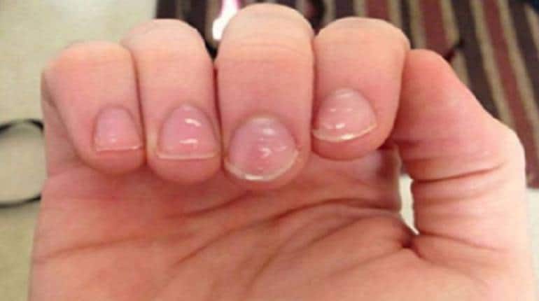 White spot on nails meaning in hindi nakhoon par safed nishaan | आपके  नाखूनों पर भी हैं सफेद निशान? जानिए किस उंगली के निशान का क्या है मतलब |  Hindi News, Zee Salaam Viral
