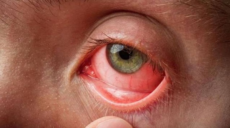 Eye Flu: बाढ़ और बारिश के बाद दिल्ली-NCR में बढ़े आंख के मरीज, लाल या  गुलाबी होने पर फौरन डॉक्टर से करें संपर्क | Moneycontrol Hindi