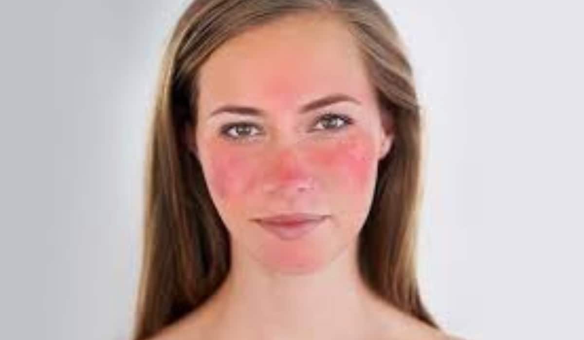 Rosacea: धूप में चेहरा हो जाता है लाल तो फौरन हो जाएं अलर्ट, डाइट में इन चीजों को करें शामिल