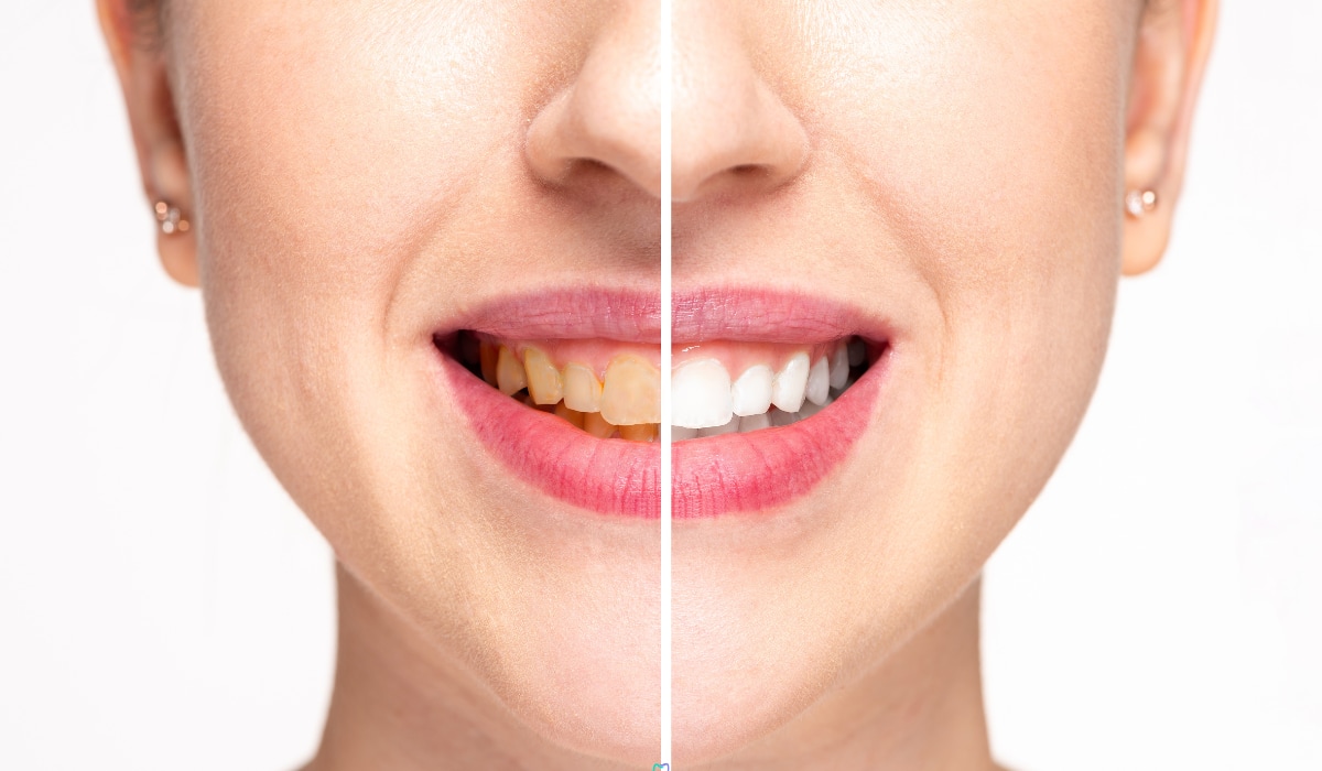 Oral Health: डेंटिस्ट के पास नहीं लगाना चाहते हैं चक्कर तो आज ही सुधारे ये आदत, वरना बढ़ सकता है कैविटी और सड़न का खतरा Oral Health: डेंटिस्ट के पास नहीं लगाना चाहते हैं चक्कर तो आज ही सुधारे ये आदत, वरना बढ़ सकता है कैविटी और सड़न का खतरा