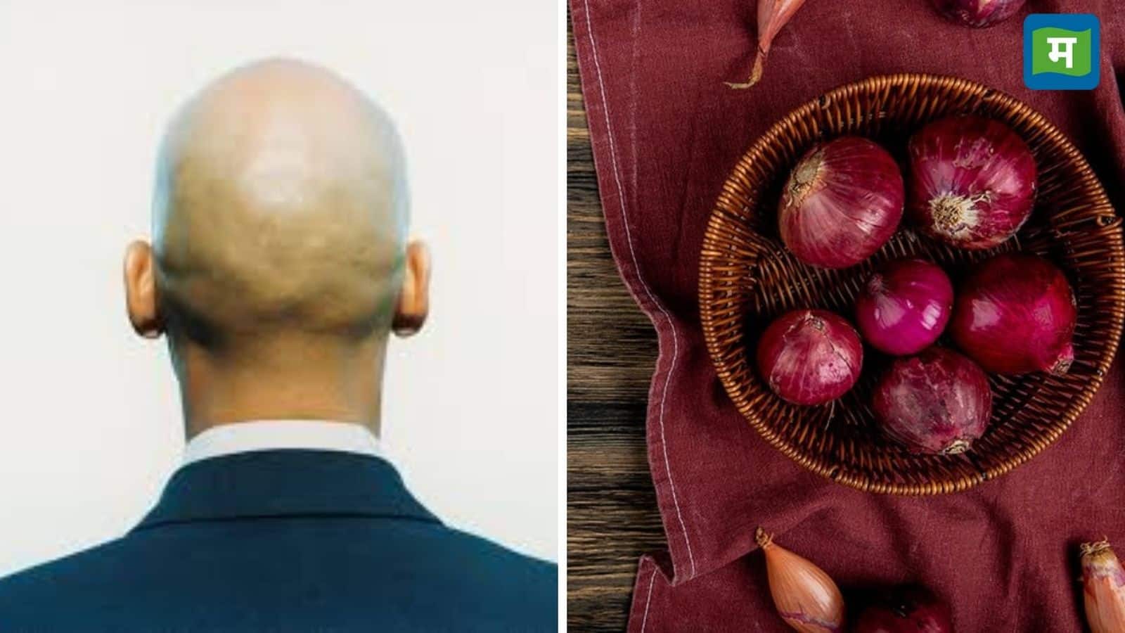 Onion Benefits: प्याज के रस से गंजे के सिर में भी उग आएंगे बाल, जानिए कैसे करें इस्तेमाल