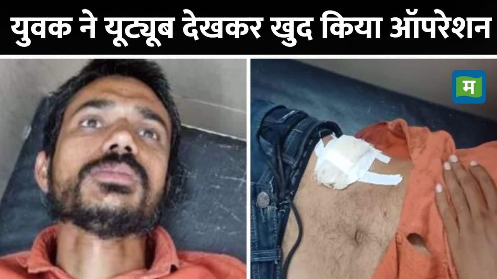 Viral News: पेट दर्द से परेशान युवक ने खुद का किया ऑपरेशन, यूट्यूब देख पेट में लगाए 11 टांके, डॉक्टरों के उड़े होश