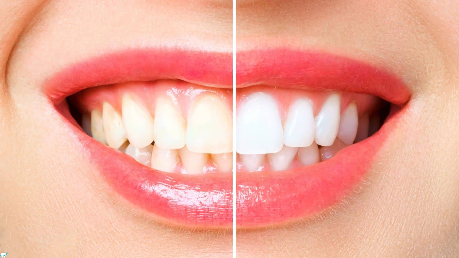 Teeth Whitening Tips: दांतों को चमकाने के लिए नहीं करनी पड़ेगी महंगी सफाई, घर पर ही अपनाएं ये तरीके