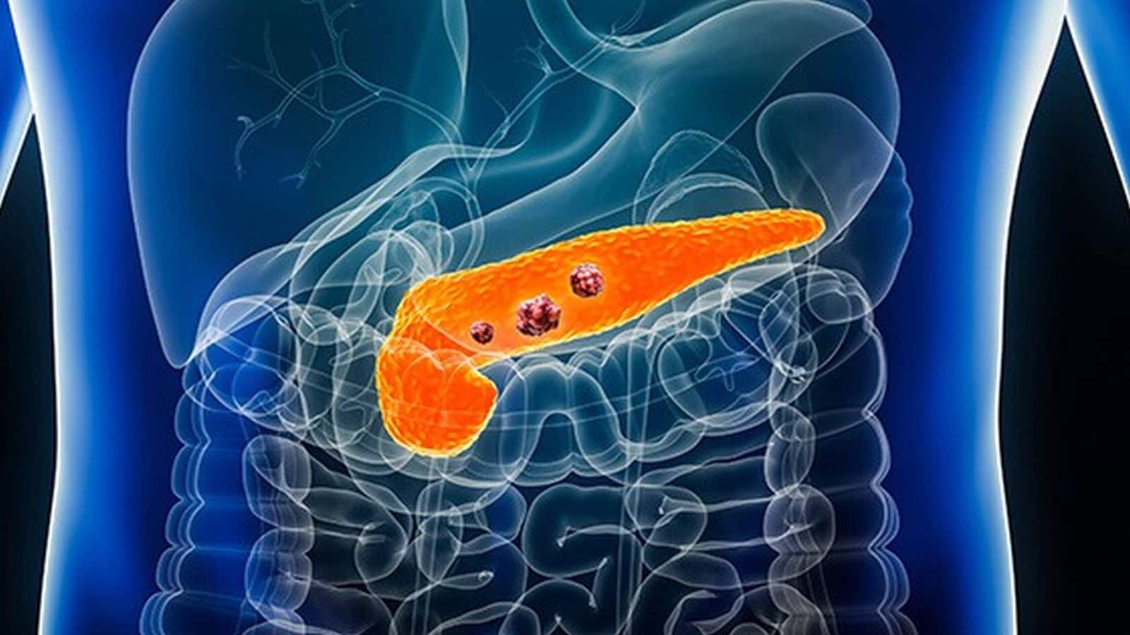 Pancreatic Cancer: पेट दर्द और पीलिया की रहती है शिकायत तो हो जाएं अलर्ट, पैंक्रियाटिक कैंसर का हो सकता है खतरा, ऐसे करें बचाव