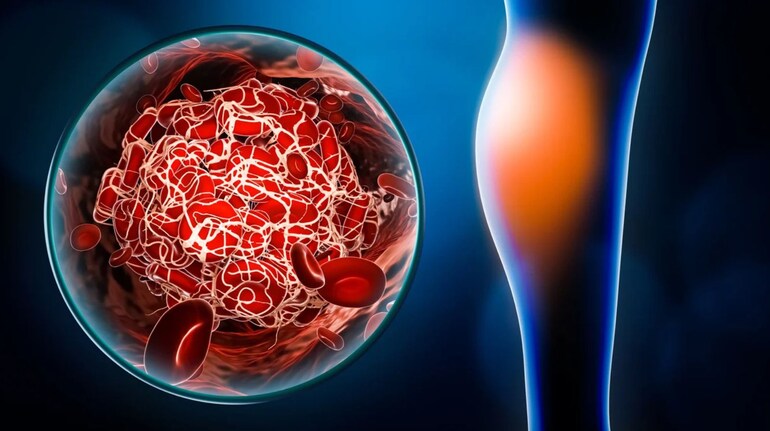 Air Embolism: सिर्फ एक इंजेक्शन की चूक से नसों में पहुंच सकती है हवा, जानें  कैसे पहचानें इसके शुरुआती लक्षण - air embolism air gas in veins symptoms  causes treatment prevention ...