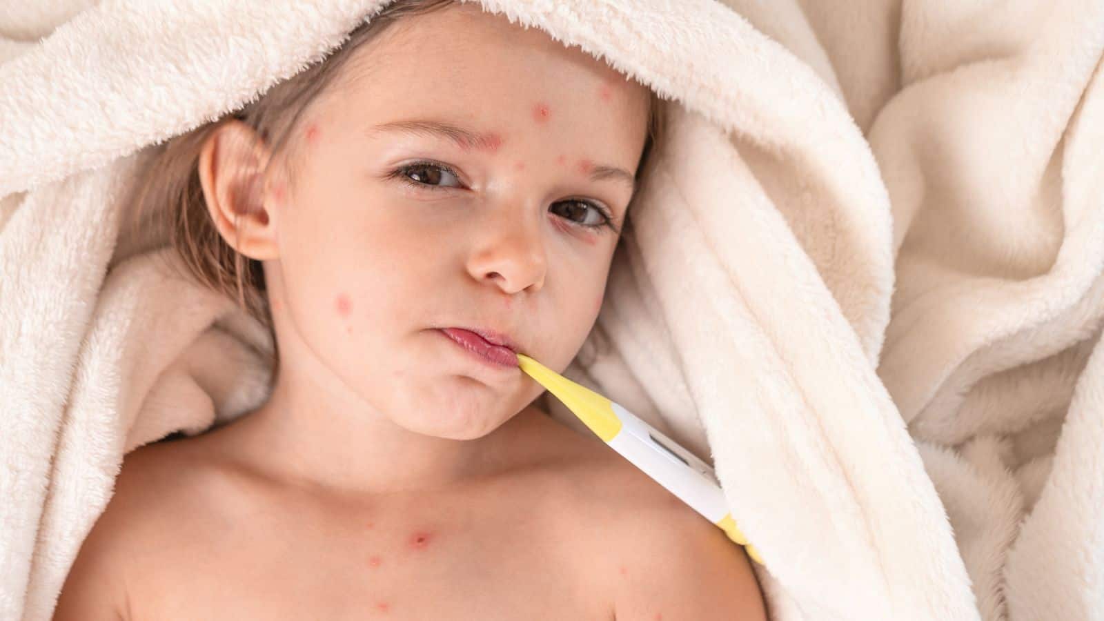 Chicken Pox: चेचक से घबराएं नहीं, सही देखभाल और घरेलू नुस्खों से जल्द मिलेगा आराम
