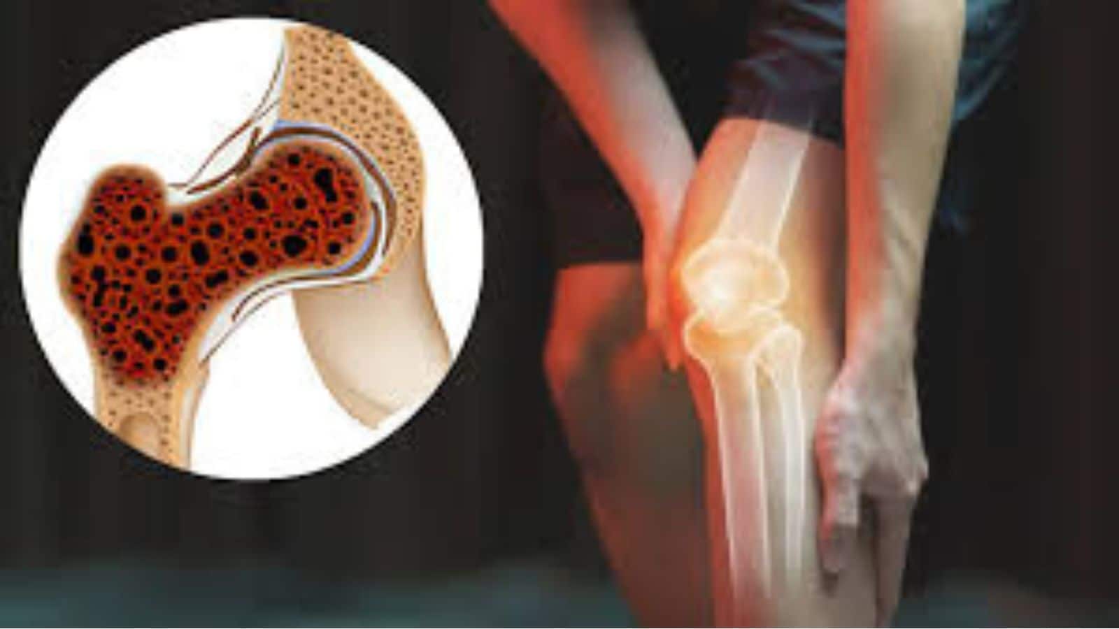 Bone Cancer: हड्डियों में लग जाता है 'दीमक' जैसा कैंसर, इन 5 लक्षणों को बिल्कुल न करें नजरअंदाज