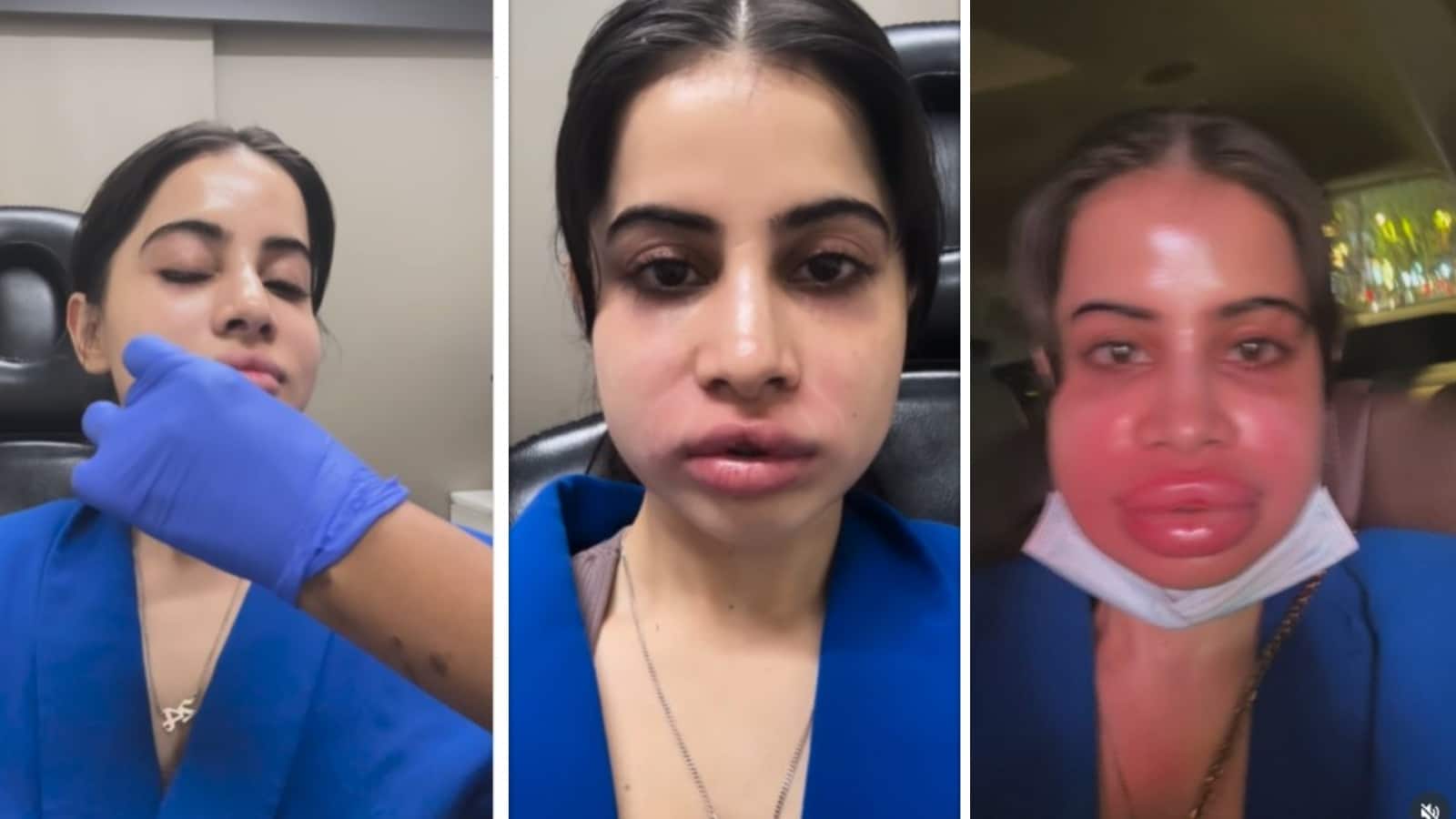 Urfi Javed Lip Filler: लिप फिलर हटाने के बाद हुआ उर्फी जावेद का हाल बेहाल,  चेहरा देख लोगों को हुई चिंता - urfi javed swollen face after getting lip  filler removed after
