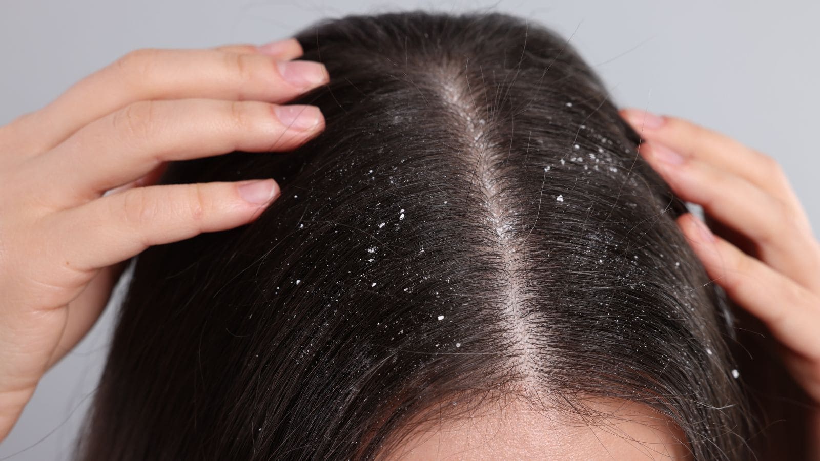 Hair Care Tips: डैंड्रफ और खुजली ने दिया परेशानियों का झटका? अपनाएं ये घरेलू उपाय और पाएं तुरंत आराम!