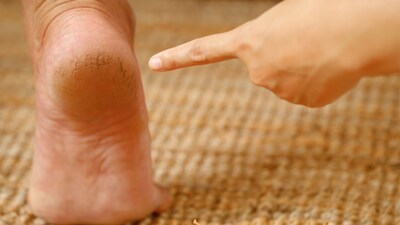 How To Use Glycerin:  रोजाना रात को ये प्रक्रिया करने से लगभग 1-2 हफ्ते में फर्क दिखाई देने लगेगा।