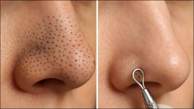Tip and Tricks: केले का छिलका सर्दियों में सेंसिटिव स्किन के लिए हल्का और सुरक्षित उपाय है।