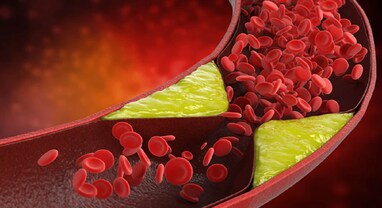 Bad Cholesterol: આ 5 આયુર્વેદિક ઉપાયો ખરાબ કોલેસ્ટ્રોલ ઘટાડવામાં તમને કરશે મદદ, હાર્ટ એટેકથી બચી જશો..! Bad Cholesterol: આ 5 આયુર્વેદિક ઉપાયો ખરાબ કોલેસ્ટ્રોલ ઘટાડવામાં તમને કરશે મદદ, હાર્ટ એટેકથી બચી જશો..!
