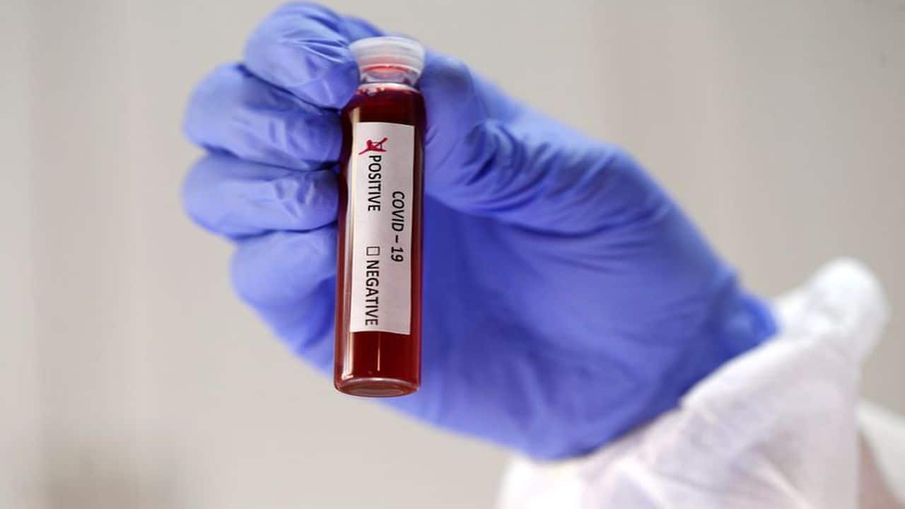 COVID-19: Do health policies cover tests done at private labs? COVID-19: Do health policies cover tests done at private labs?