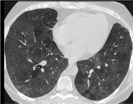 Answer: Ground glass. In radiology, ground glass opacity (GGO) is a nonspecific finding on computed tomography scans (CT) consisting of a hazy opacity that does not obscure the underlying bronchial structures or pulmonary vessels, that indicates a partial filling of air spaces in the lungs by exudate or transudate, as well as interstitial thickening or partial collapse of lung alveoli. It is one of the major symptoms of coronavirus. Answer: Ground glass. In radiology, ground glass opacity (GGO) is a nonspecific finding on computed tomography scans (CT) consisting of a hazy opacity that does not obscure the underlying bronchial structures or pulmonary vessels, that indicates a partial filling of air spaces in the lungs by exudate or transudate, as well as interstitial thickening or partial collapse of lung alveoli. It is one of the major symptoms of coronavirus.