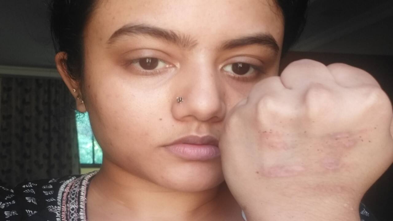 Coronavirus pandemic | Fresh reports of burns from quarantine stamp despite Goa govt assuring safer ink Coronavirus pandemic | Fresh reports of burns from quarantine stamp despite Goa govt assuring safer ink
