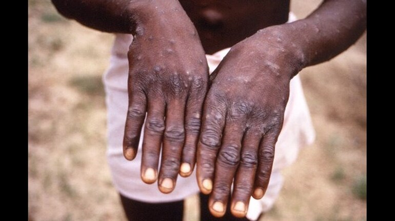 Monkeypox is a disease that causes fevers and skin lesions. 