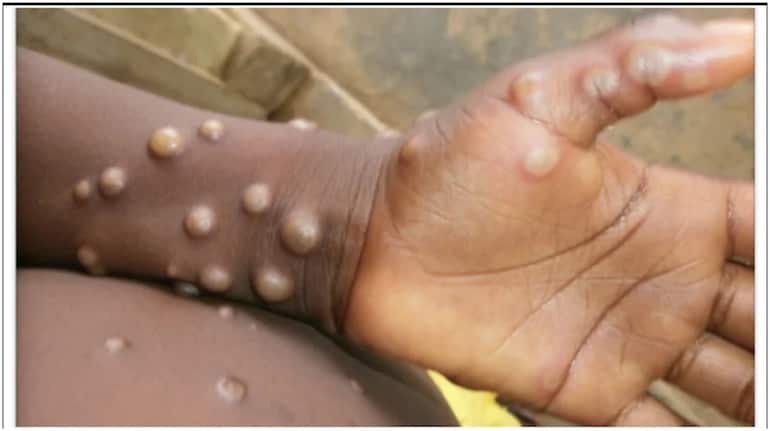 Monkeypox often starts with flu-like symptoms before causing a chickenpox-like rash on the face and body.