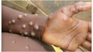 Monkeypox isn’t looking like a COVID-19-sized threat