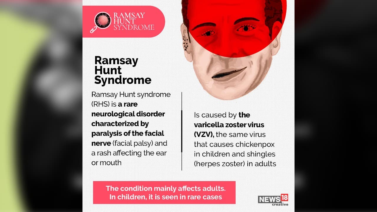 Wephysio MFC - Ramsay hunt syndrome 🔵 Ramsay Hunt syndrome (RHS) occurs by  reactivation of the varicella-zoster virus which cause chickenpox and  shingles at the geniculate ganglion. 🔵 Clinical presentation of Ramsay