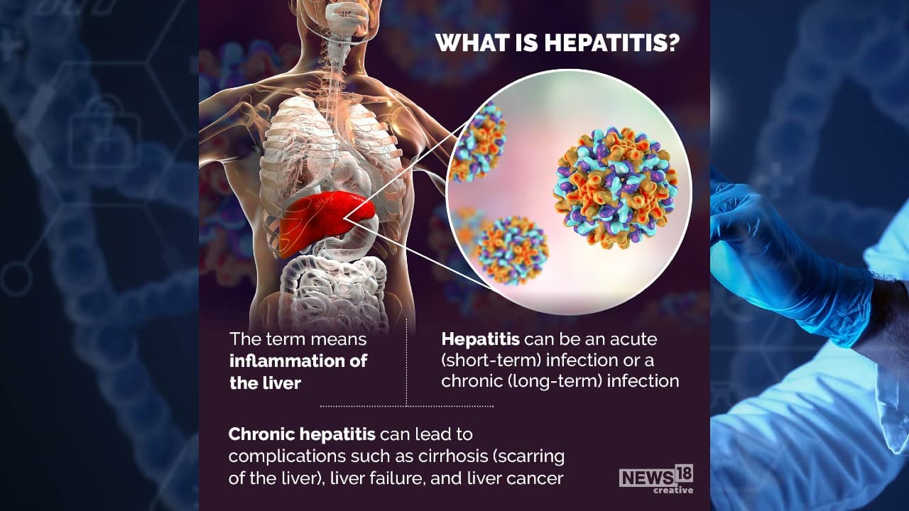 The term means inflammation of the liver. Hepatitis can be an acute (short-term) infection or a chromic (long-term) infection. (Image: News18 Creative)