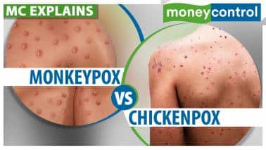 Monkeypox: How is it different from chickenpox | Explained