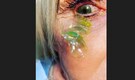 Woman has 23 contact lenses removed from her eye. Video is viral