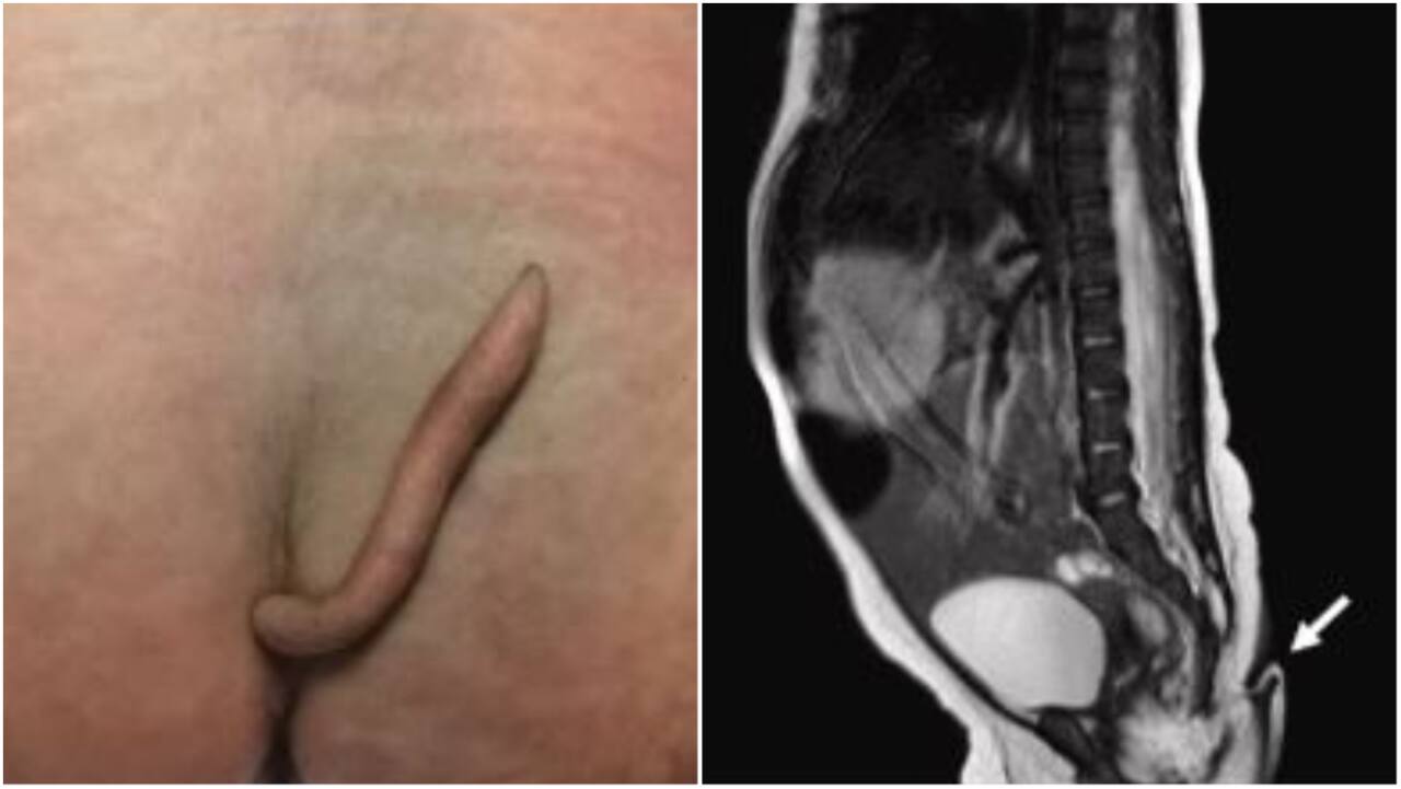 Baby girl born with 'extremely rare' 2-inch-long hairy tail surprises doctors
