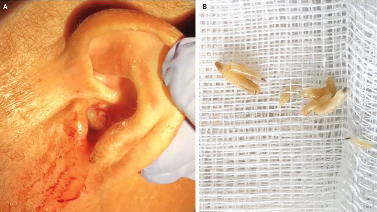 Flesh-eating maggots found inside man's ear. They were eating his eardrum