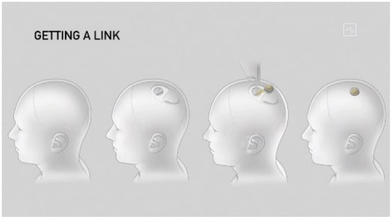 Neuralink’s first brain implant patient reveals how the technology ...