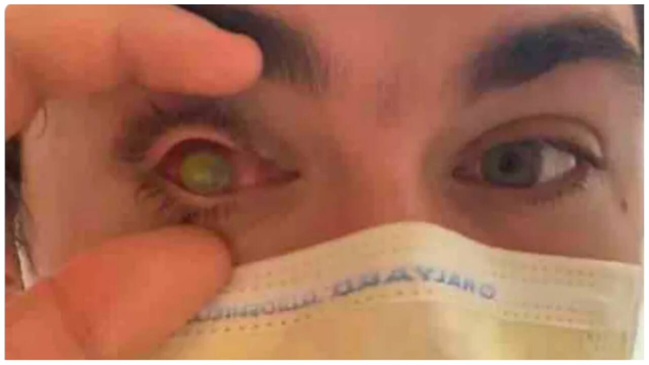 Bengaluru start-up, Shroff eye hospital develop ‘bioengineered cornea’, to seek DCGI nod for human trials Bengaluru start-up, Shroff eye hospital develop ‘bioengineered cornea’, to seek DCGI nod for human trials