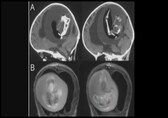 Parasitic twin removed from brain of one-year-old in China
