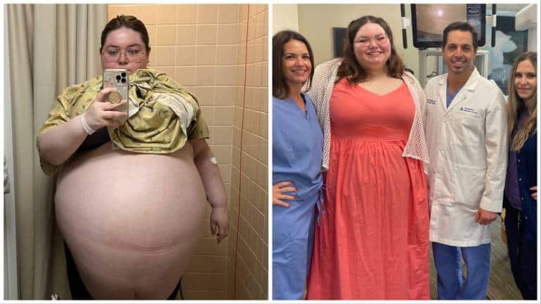 Ovarian Cyst Removal And Weight Loss