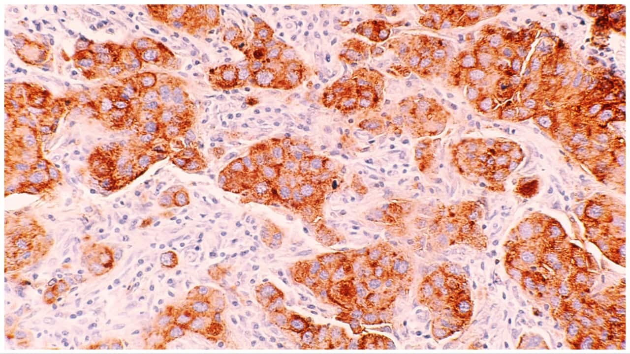 Merck, Seagen drug cocktail seen as new bladder cancer standard