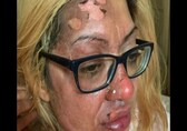 Cooking eggs in microwave left woman with skin peeling from face