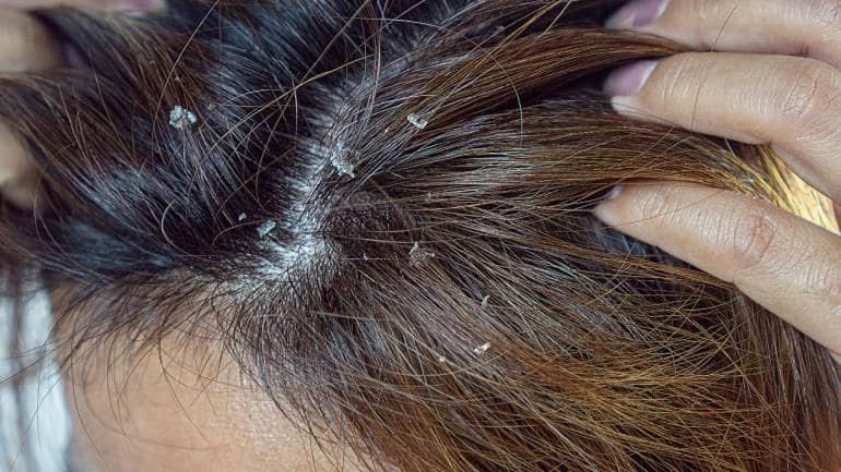 Scalp psoriasis causes (Image: Canva)