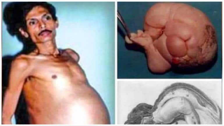 Man found 'pregnant' with twin for 36 years due to rare medical condition - Vimarsana News