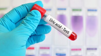 High uric acid levels (Image: Canva)