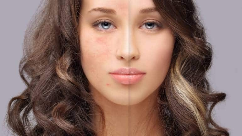 Home remedies to treat acne (Image: Canva)