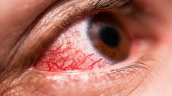 Bacterial conjunctivitis leads to sticky puss in the eye.