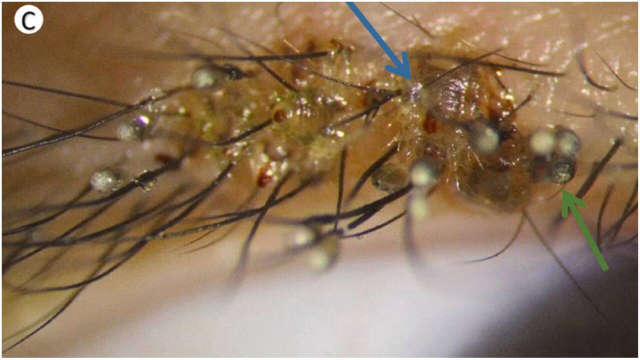 Doctors find 'large number of' lice, eggs on 3-year-old Chinese boy's eyelashes. See pics
