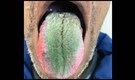 Man gets 'hairy, green tongue' due to smoking and simultaneous antibiotics use