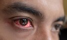Conjunctivitis symptoms, and 10 most effective tips to manage pink eye in rainy season