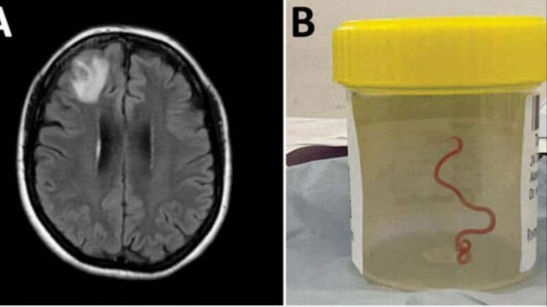 Live worm found in woman's brain in world's first such case - Vimarsana News