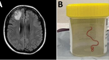 Live worm in brain