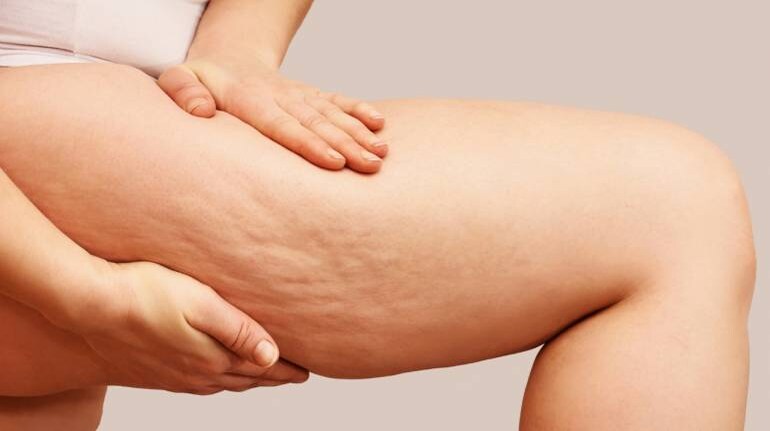 Best treatment for cellulite: Expert dermatologists tell us what really  works